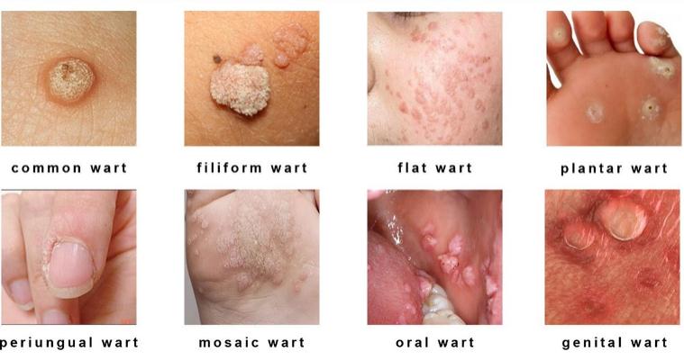 skin-warts-ke-karan